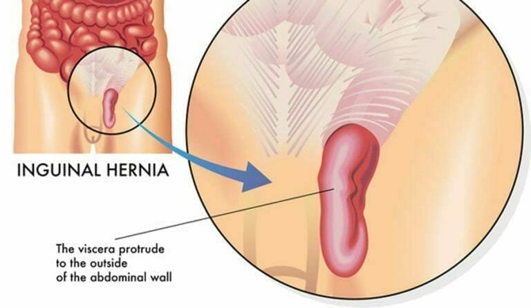 Inguinal Hernias Benjamin E. Johnson MD